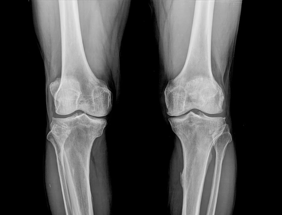 Knee Xray